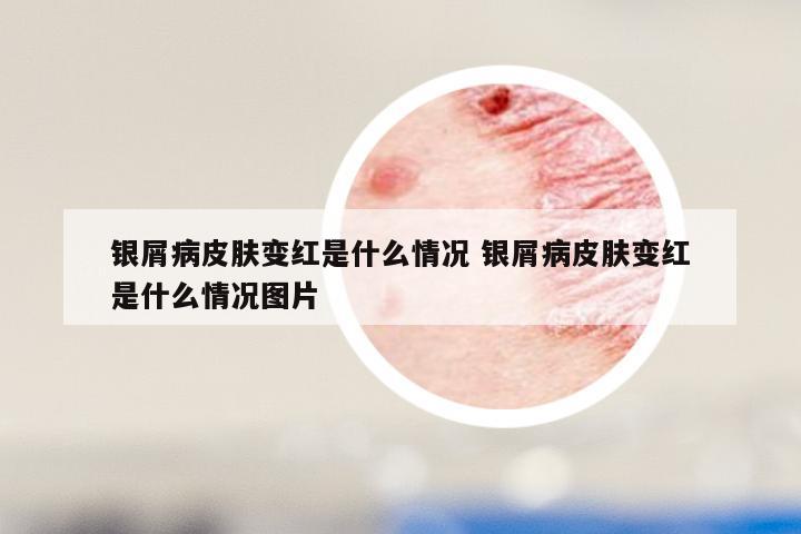 银屑病皮肤变红是什么情况 银屑病皮肤变红是什么情况图片