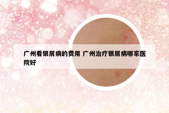 广州看银屑病的费用 广州治疗银屑病哪家医院好