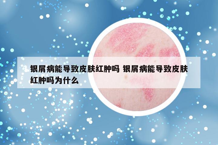 银屑病能导致皮肤红肿吗 银屑病能导致皮肤红肿吗为什么