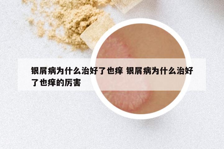 银屑病为什么治好了也痒 银屑病为什么治好了也痒的厉害