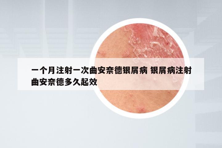 一个月注射一次曲安奈德银屑病 银屑病注射曲安奈德多久起效