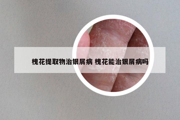 槐花提取物治银屑病 槐花能治银屑病吗