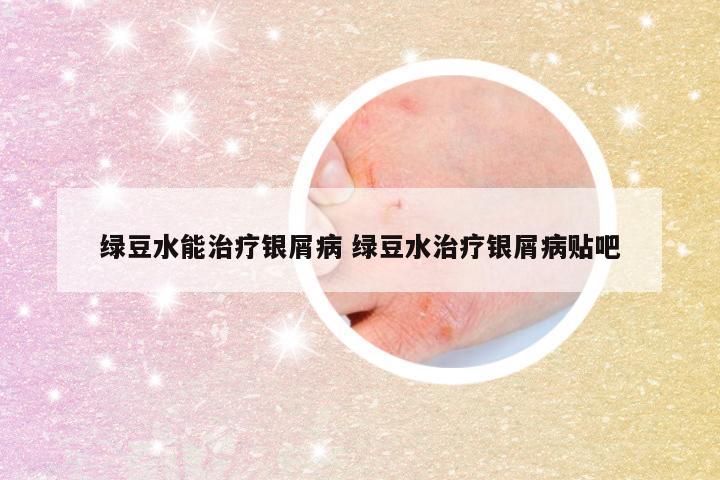 绿豆水能治疗银屑病 绿豆水治疗银屑病贴吧