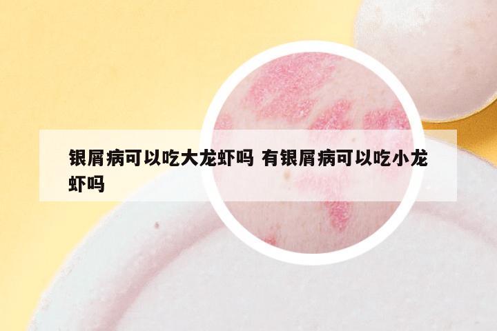 银屑病可以吃大龙虾吗 有银屑病可以吃小龙虾吗