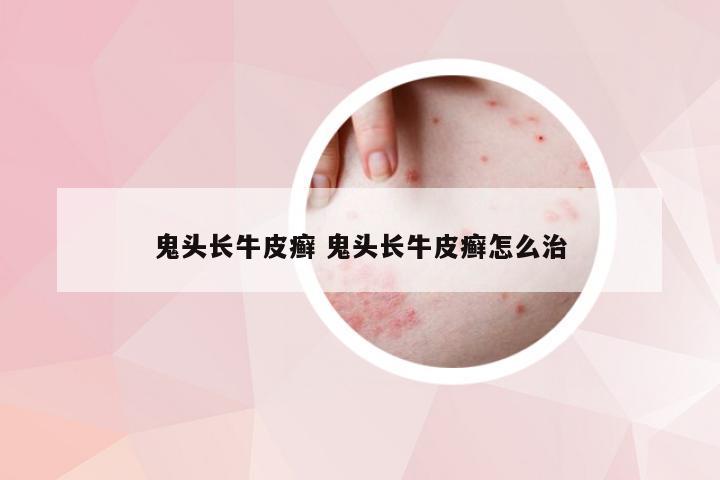 鬼头长牛皮癣 鬼头长牛皮癣怎么治