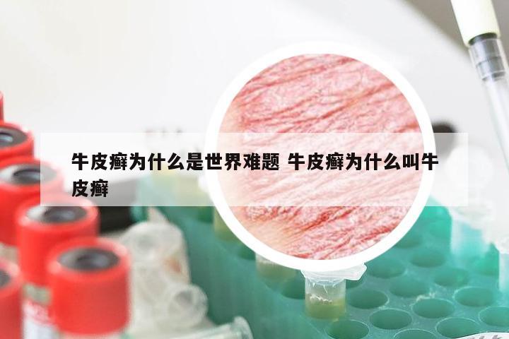 牛皮癣为什么是世界难题 牛皮癣为什么叫牛皮癣