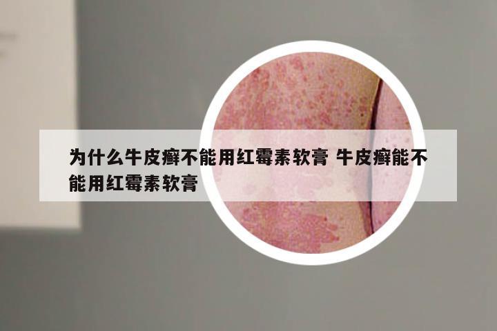 为什么牛皮癣不能用红霉素软膏 牛皮癣能不能用红霉素软膏