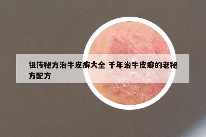 祖传秘方治牛皮癣大全 千年治牛皮癣的老秘方配方