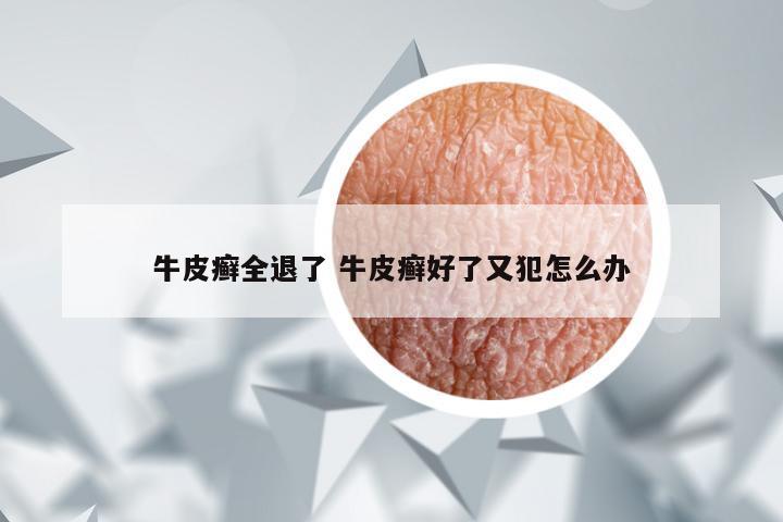 牛皮癣全退了 牛皮癣好了又犯怎么办