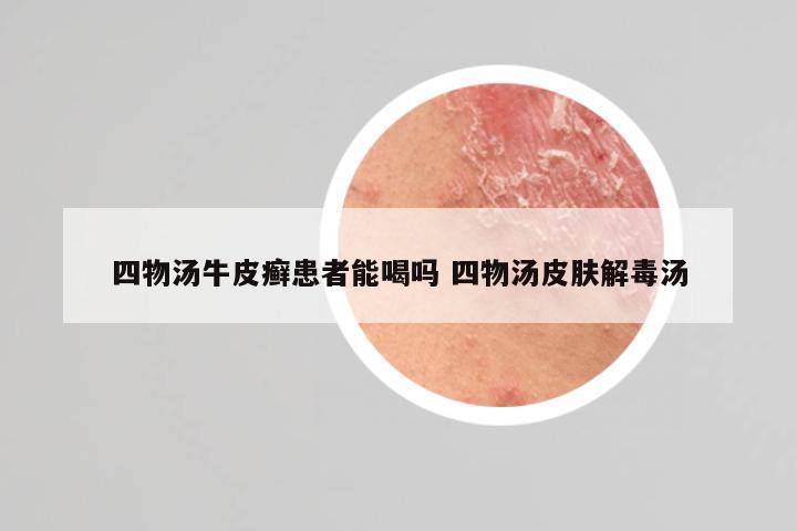 四物汤牛皮癣患者能喝吗 四物汤皮肤解毒汤