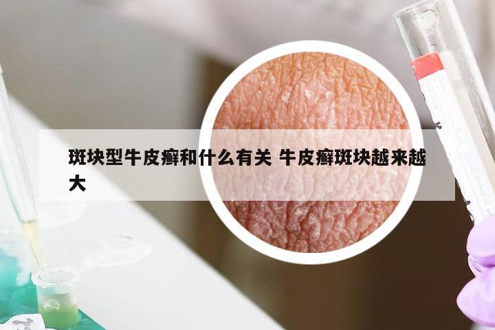 斑块型牛皮癣和什么有关 牛皮癣斑块越来越大