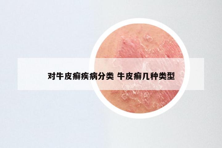 对牛皮癣疾病分类 牛皮癣几种类型