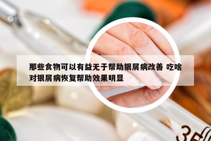 那些食物可以有益无于帮助银屑病改善 吃啥对银屑病恢复帮助效果明显