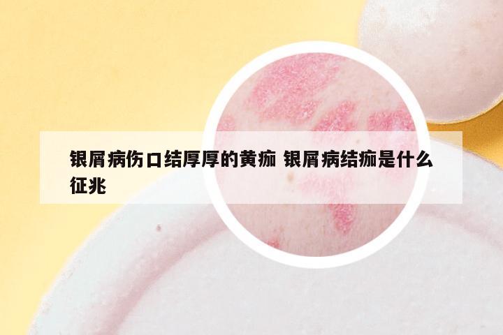银屑病伤口结厚厚的黄痂 银屑病结痂是什么征兆