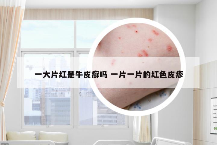 一大片红是牛皮癣吗 一片一片的红色皮疹