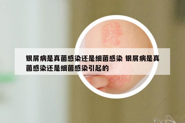 银屑病是真菌感染还是细菌感染 银屑病是真菌感染还是细菌感染引起的