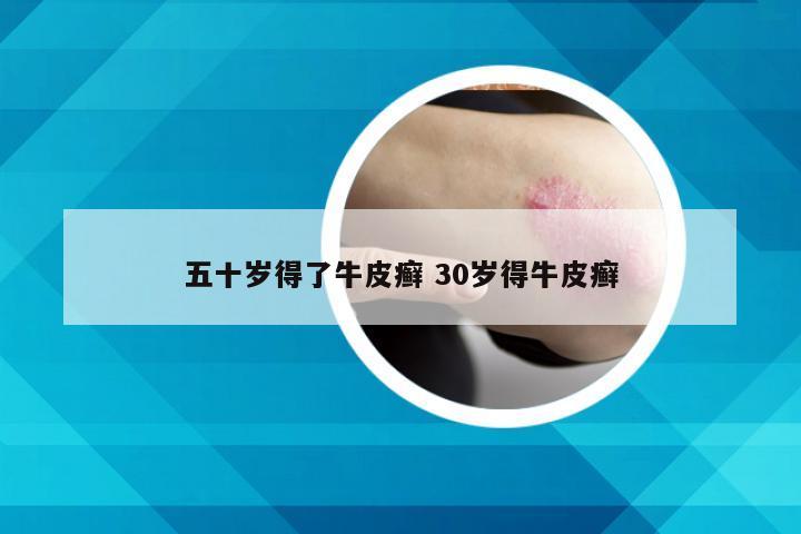 五十岁得了牛皮癣 30岁得牛皮癣