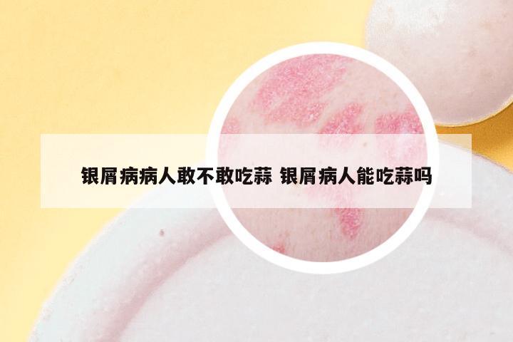 银屑病病人敢不敢吃蒜 银屑病人能吃蒜吗