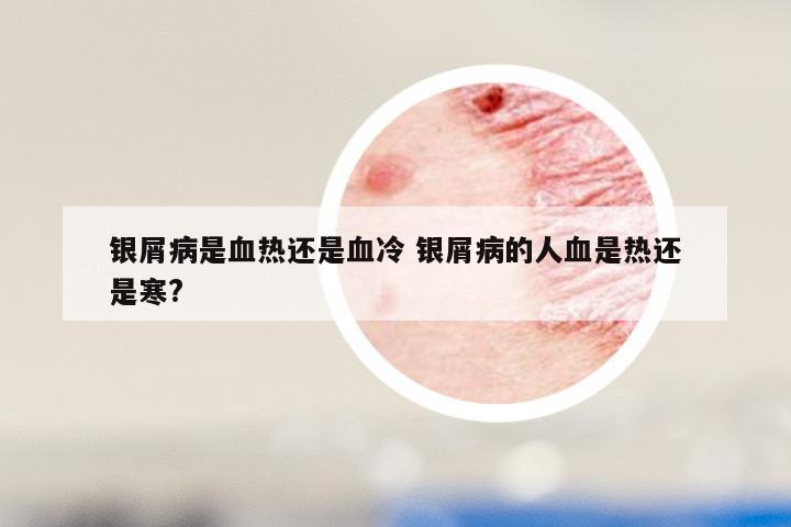 银屑病是血热还是血冷 银屑病的人血是热还是寒?