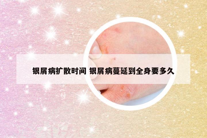 银屑病扩散时间 银屑病蔓延到全身要多久