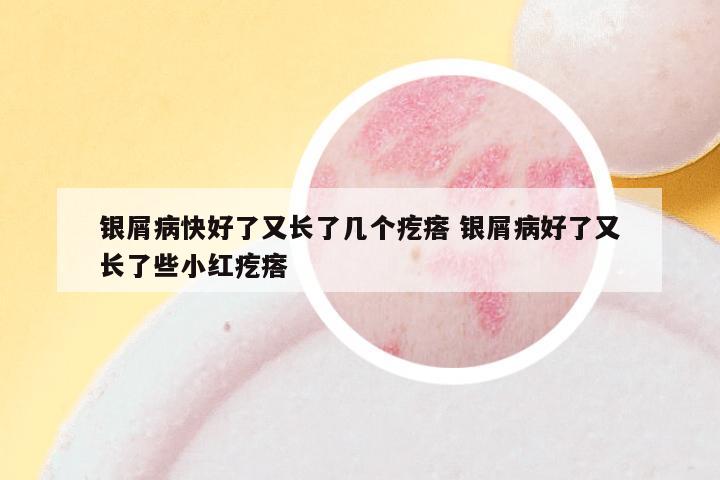 银屑病快好了又长了几个疙瘩 银屑病好了又长了些小红疙瘩