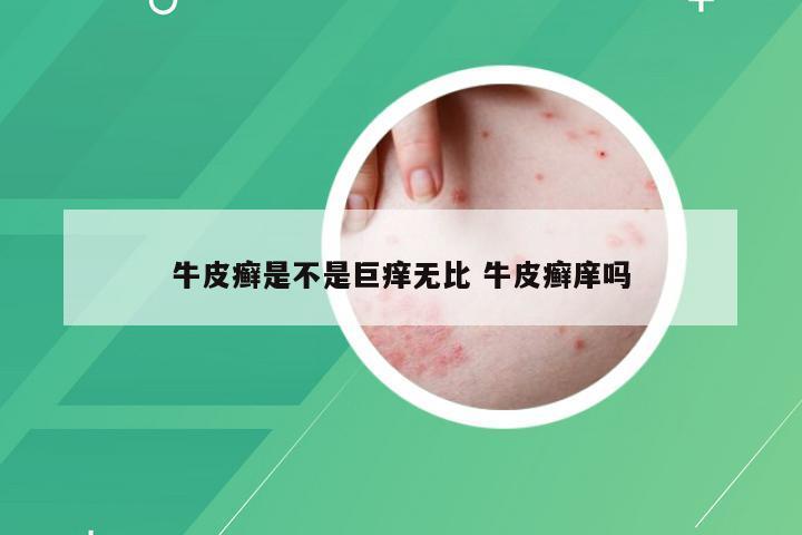 牛皮癣是不是巨痒无比 牛皮癣庠吗