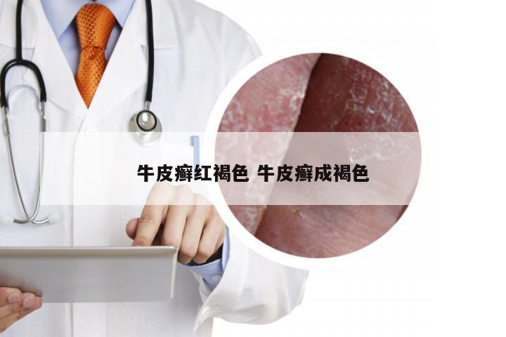 牛皮癣红褐色 牛皮癣成褐色