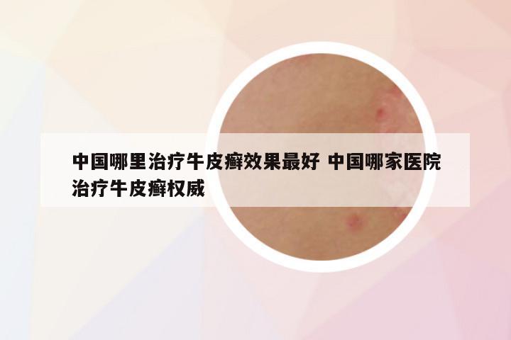 中国哪里治疗牛皮癣效果最好 中国哪家医院治疗牛皮癣权威