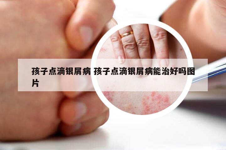 孩子点滴银屑病 孩子点滴银屑病能治好吗图片