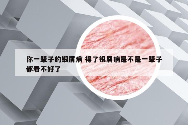 你一辈子的银屑病 得了银屑病是不是一辈子都看不好了