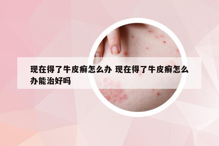 现在得了牛皮癣怎么办 现在得了牛皮癣怎么办能治好吗