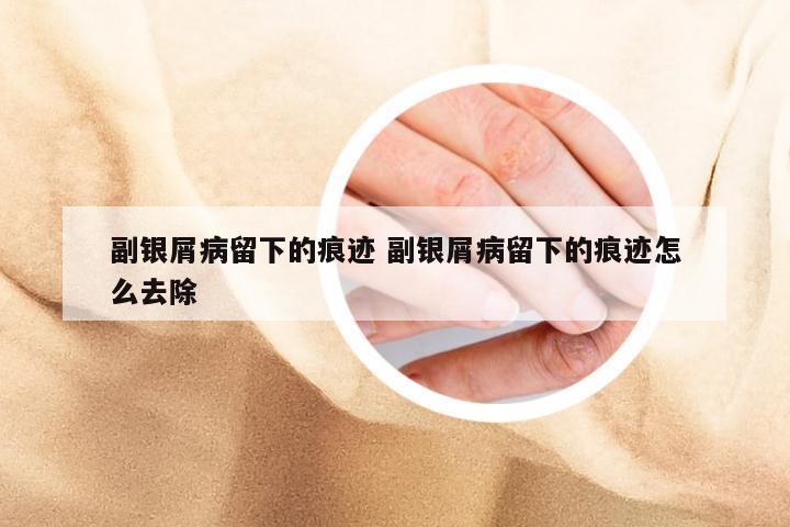 副银屑病留下的痕迹 副银屑病留下的痕迹怎么去除