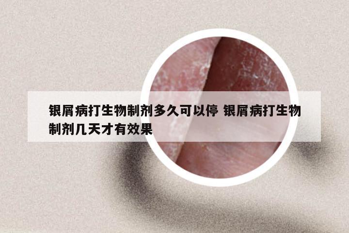 银屑病打生物制剂多久可以停 银屑病打生物制剂几天才有效果