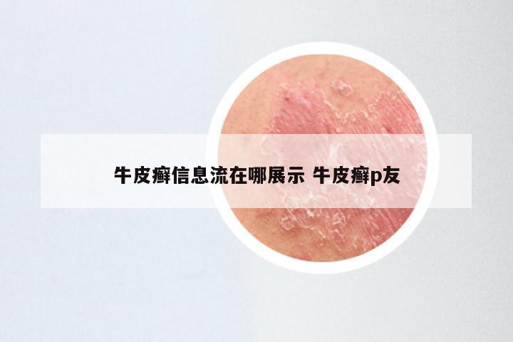牛皮癣信息流在哪展示 牛皮癣p友