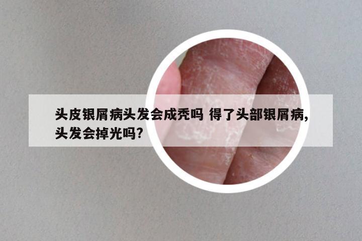 头皮银屑病头发会成秃吗 得了头部银屑病,头发会掉光吗?