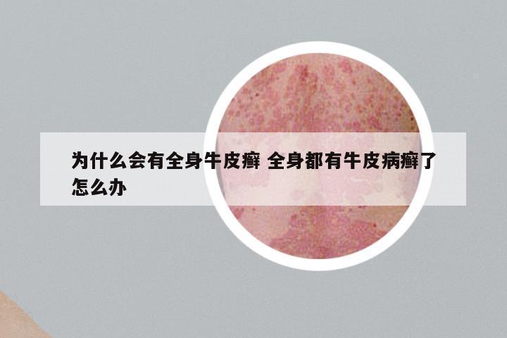 为什么会有全身牛皮癣 全身都有牛皮病癣了怎么办