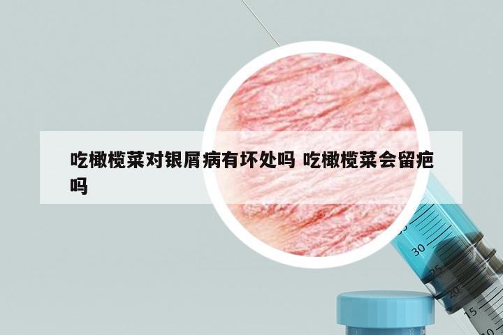 吃橄榄菜对银屑病有坏处吗 吃橄榄菜会留疤吗