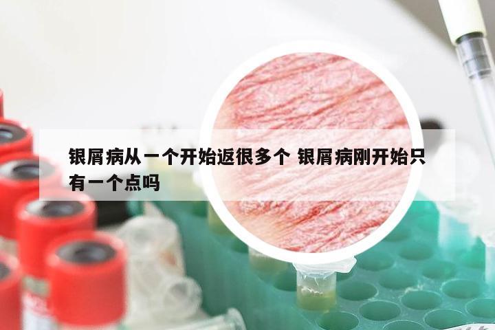 银屑病从一个开始返很多个 银屑病刚开始只有一个点吗