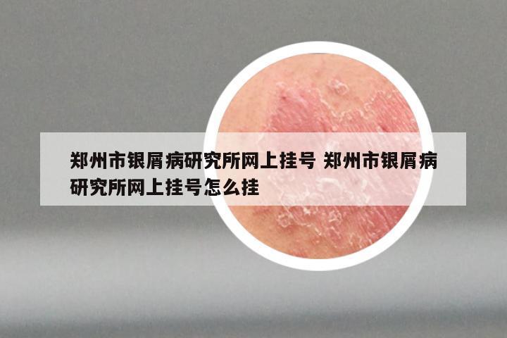 郑州市银屑病研究所网上挂号 郑州市银屑病研究所网上挂号怎么挂