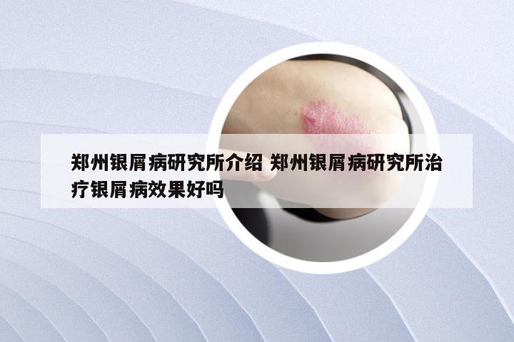 郑州银屑病研究所介绍 郑州银屑病研究所治疗银屑病效果好吗