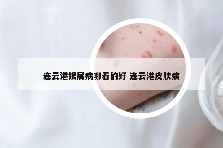 连云港银屑病哪看的好 连云港皮肤病