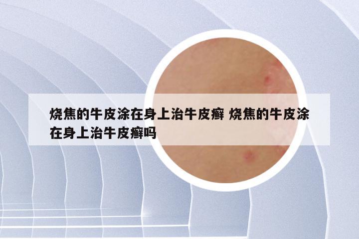 烧焦的牛皮涂在身上治牛皮癣 烧焦的牛皮涂在身上治牛皮癣吗