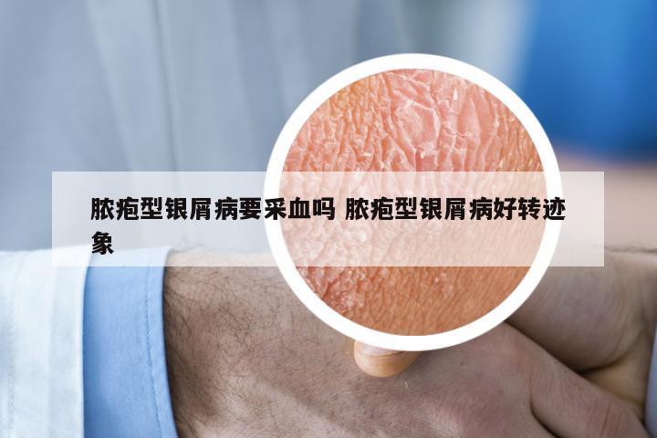 脓疱型银屑病要采血吗 脓疱型银屑病好转迹象