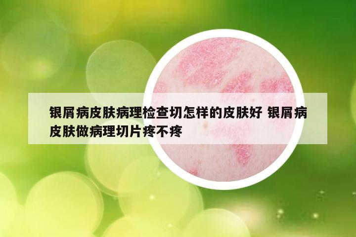 银屑病皮肤病理检查切怎样的皮肤好 银屑病皮肤做病理切片疼不疼