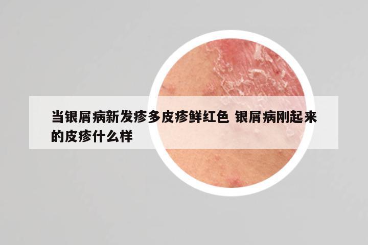当银屑病新发疹多皮疹鲜红色 银屑病刚起来的皮疹什么样