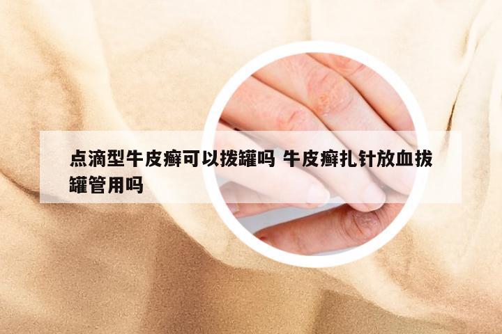 点滴型牛皮癣可以拨罐吗 牛皮癣扎针放血拔罐管用吗