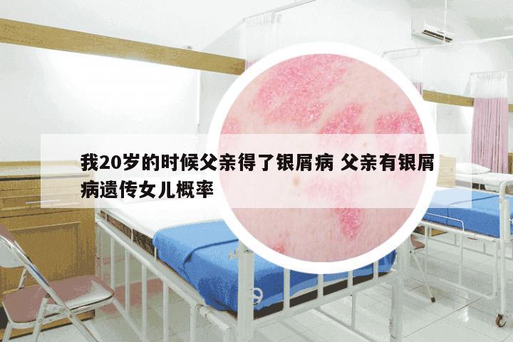 我20岁的时候父亲得了银屑病 父亲有银屑病遗传女儿概率