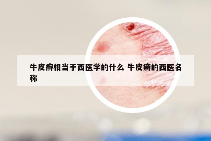 牛皮癣相当于西医学的什么 牛皮癣的西医名称