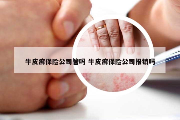 牛皮癣保险公司管吗 牛皮癣保险公司报销吗