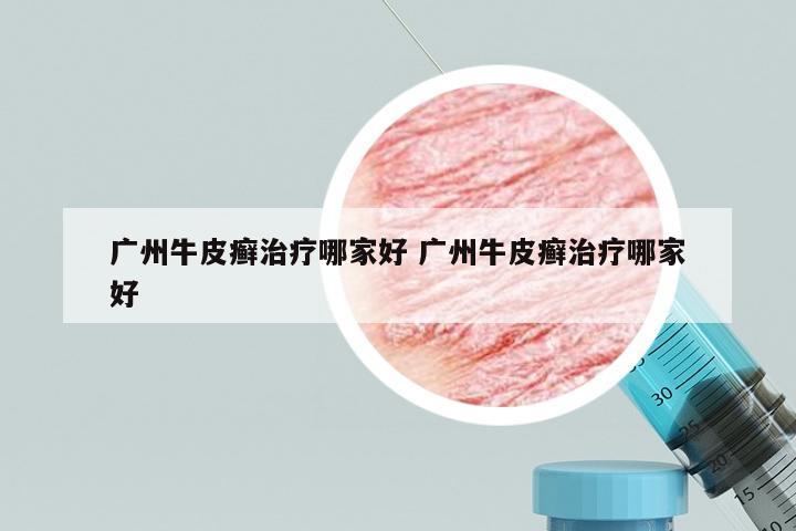 广州牛皮癣治疗哪家好 广州牛皮癣治疗哪家好